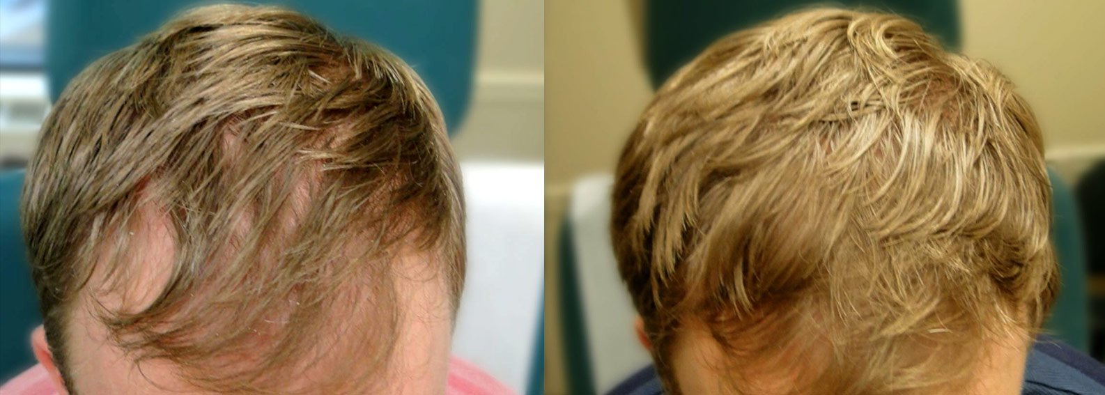 Before & After of PRP Therapy