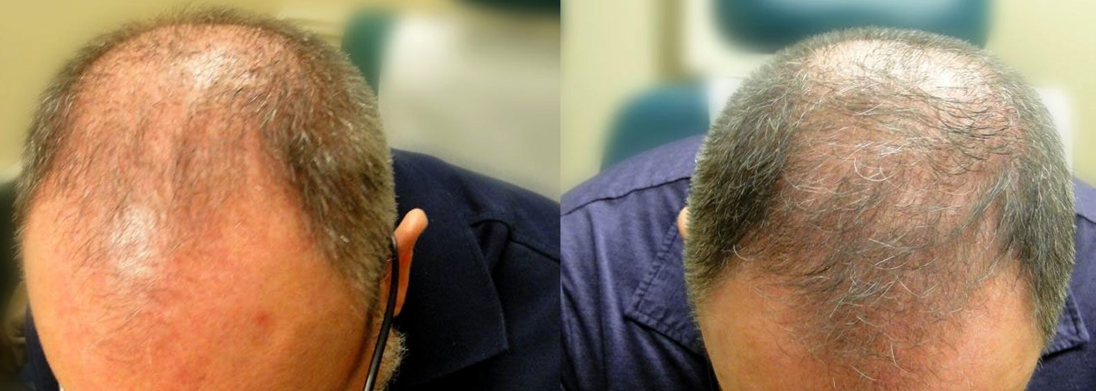 Before After of Crown Hair Restoration