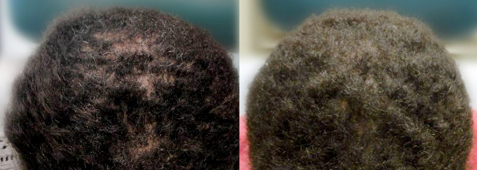 Before After Ethnic Hair Transplant