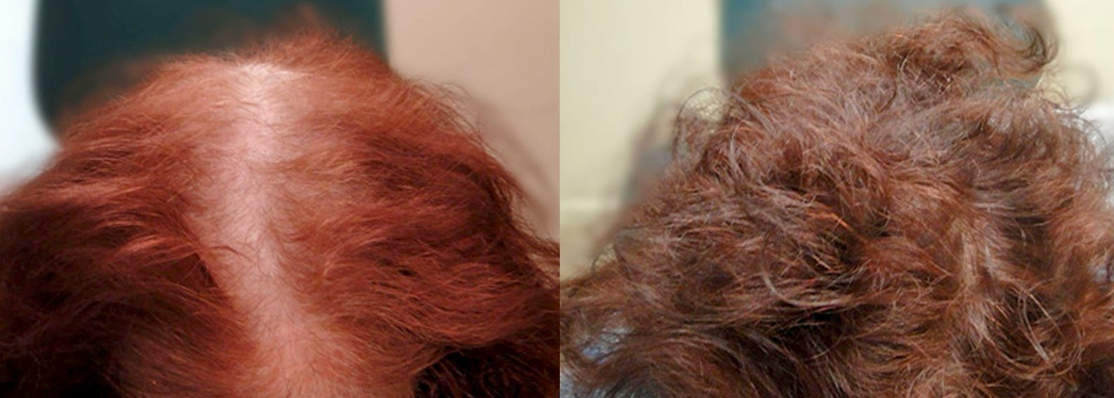 Before & After PRP Hair Restoration Treatment