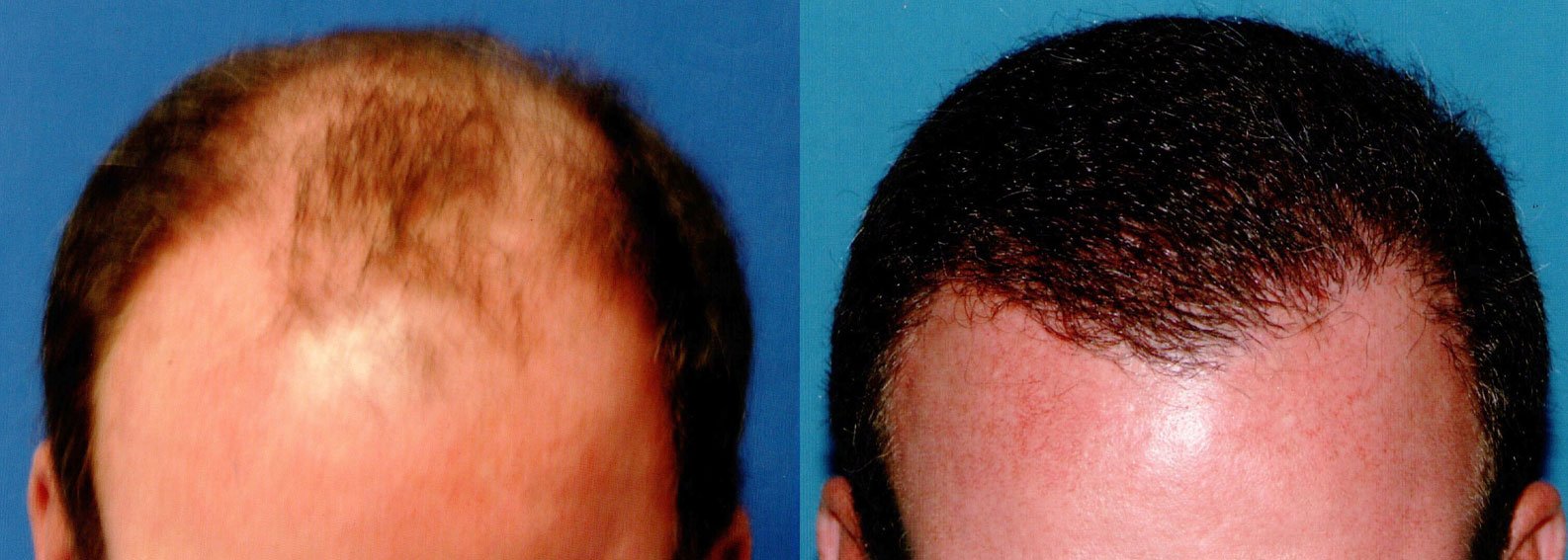 Before & After Photos of FUE Transplant with amazing results. Follicular Unit Excision creates natural looking results.