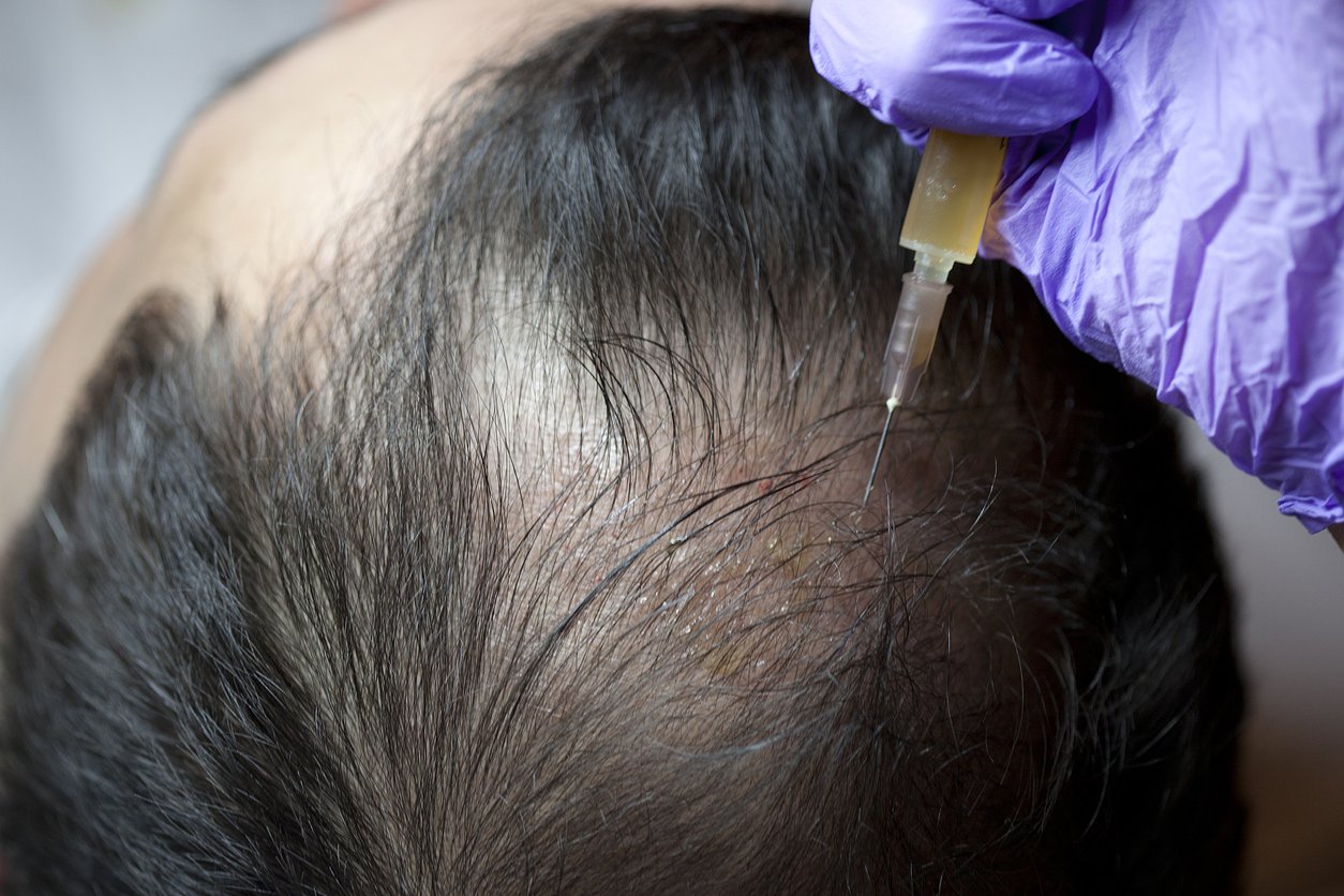 How Can Stem Cells Help Hair Regrowth Darling Hair Restoration 2787