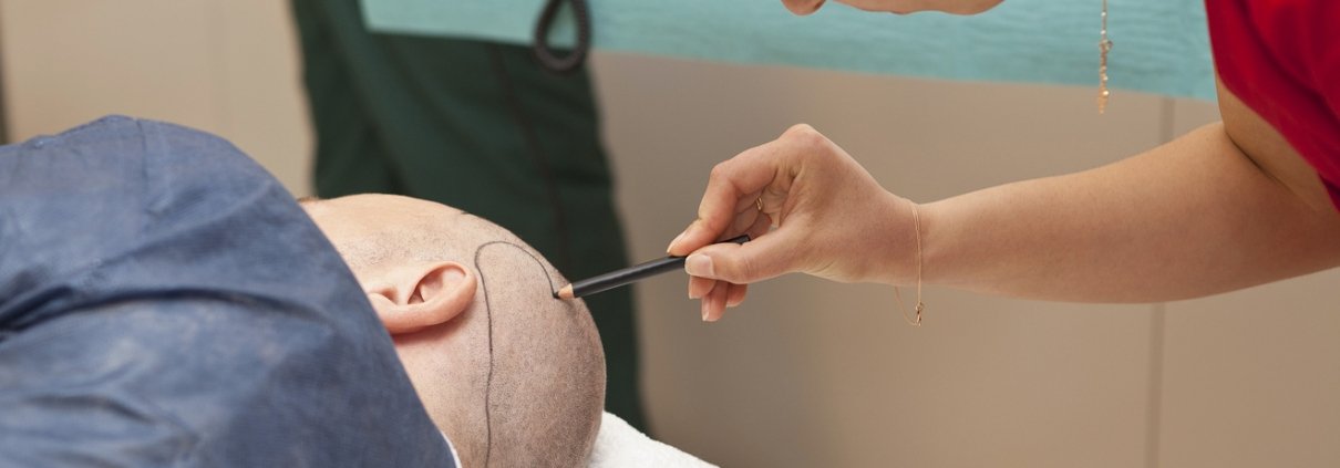 hair transplant surgery