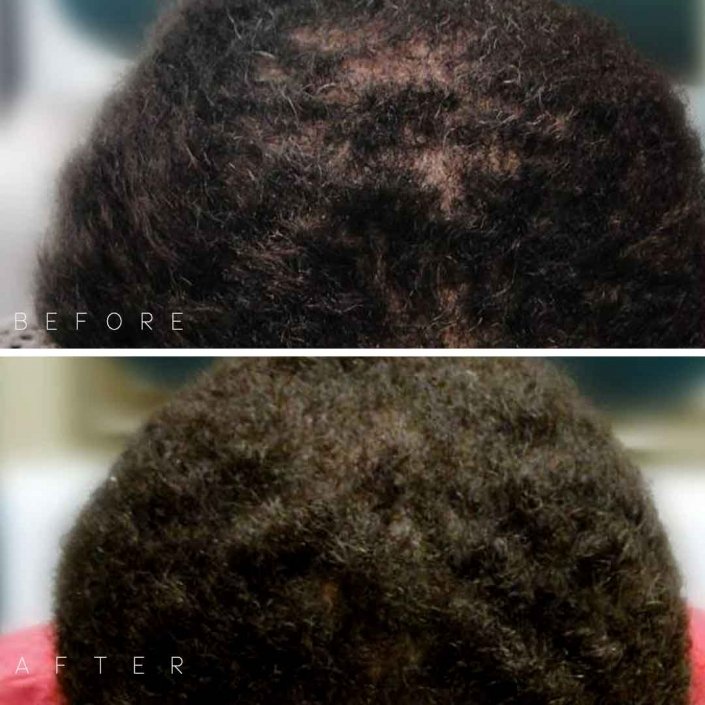 Darling Hair Restoration Before & After Photo