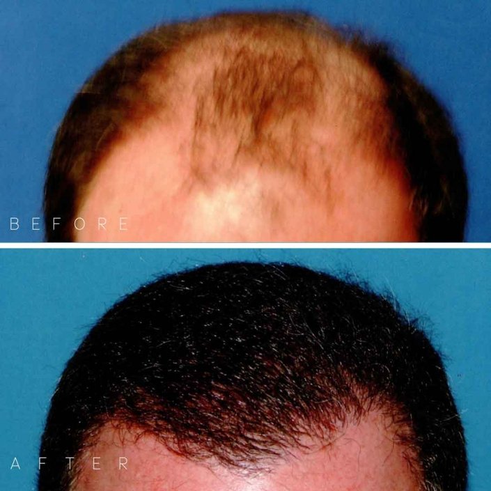 Darling Hair Restoration Before & After Photo