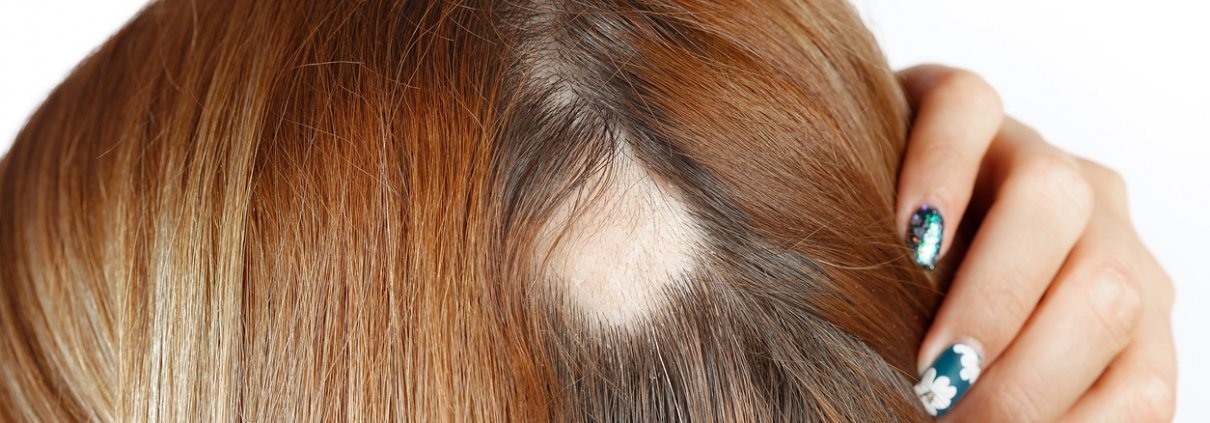 Alopecia Treatment - Alopecia areata