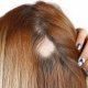 Alopecia Treatment - Alopecia areata