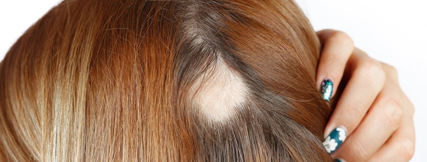 Alopecia Treatment - Alopecia areata