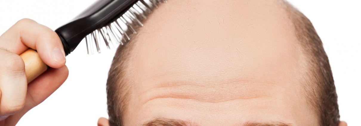 men hair loss