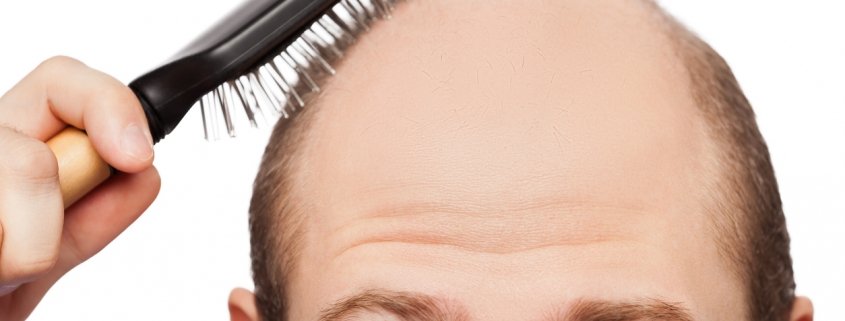 men hair loss