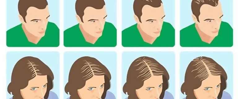 Women's Vs Men's Hair loss