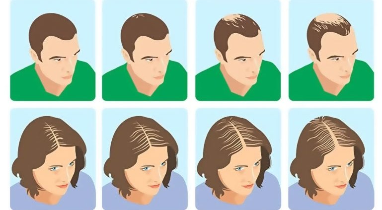 Women's Vs Men's Hair loss