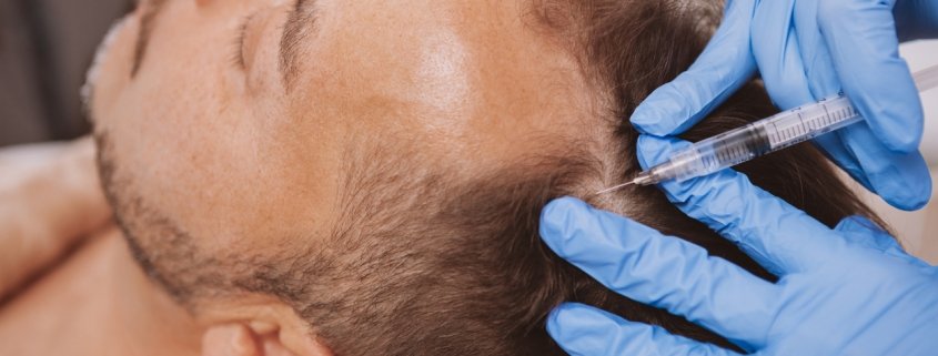hair loss