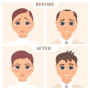 Transgender Hair Transplants