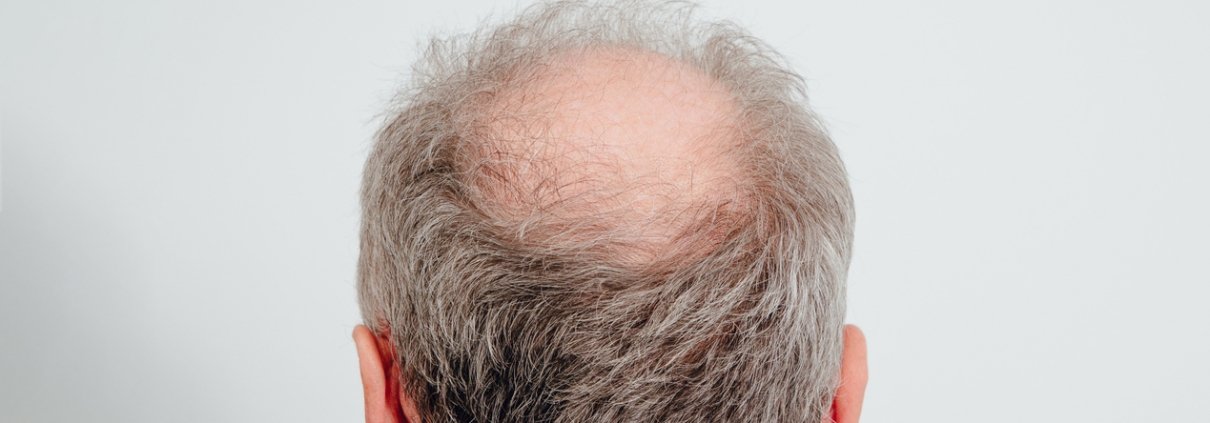 thinning hair