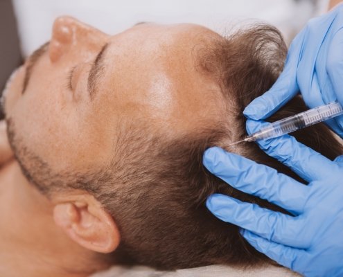 Scalp Injections