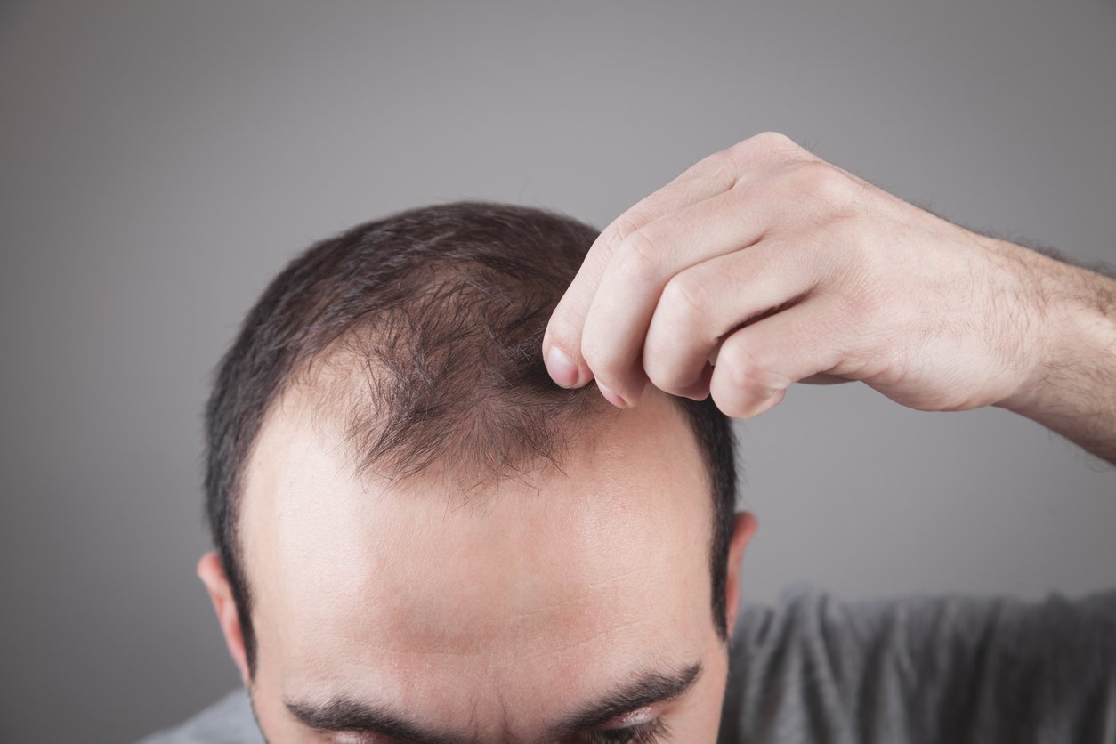 How to Stop and Regrow a Receding Hairline Darling Hair Restoration.