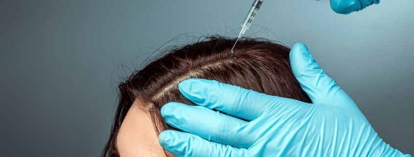 Are Stem Cell and PRP Therapy Effective for Hair Regrowth? – Darling Hair  Restoration