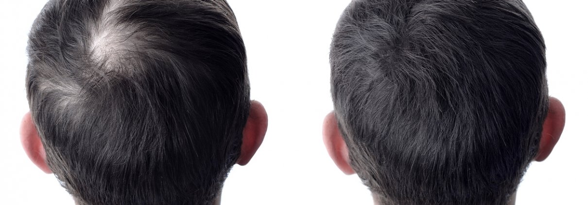 male hair loss