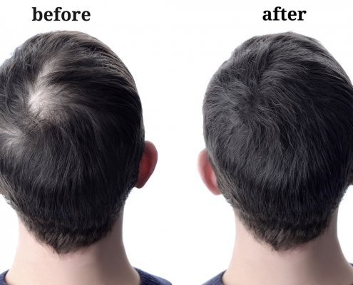 male hair loss