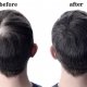 male hair loss