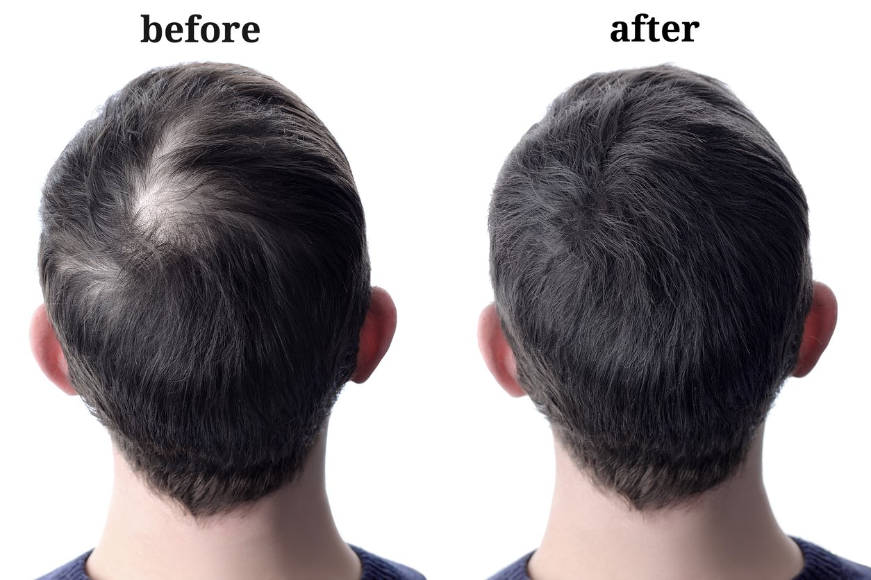 Progression of Hair Loss in Men | Darling Hair Restoration