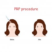 PRP Therapy for Hair