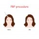 PRP Therapy for Hair