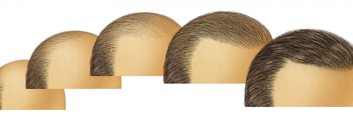 hair transplant