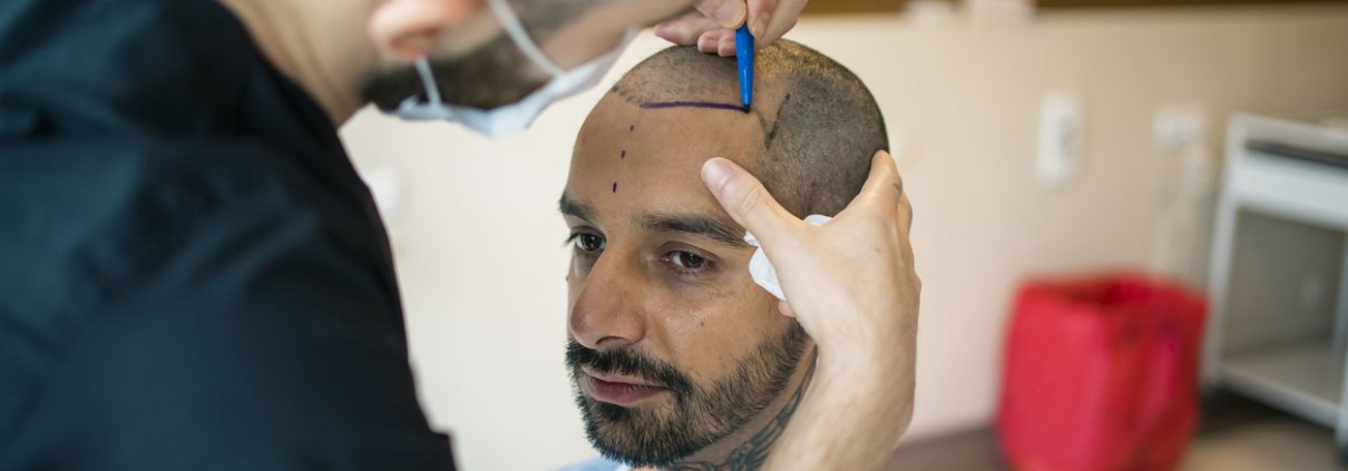 A bald man getting an outline of where his hairline should be by a physician that is going to perform a hair transplant.