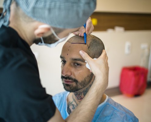 A bald man getting an outline of where his hairline should be by a physician that is going to perform a hair transplant.