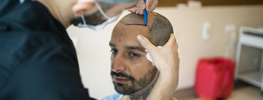 A bald man getting an outline of where his hairline should be by a physician that is going to perform a hair transplant.