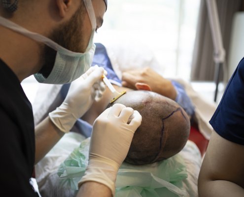 Hair transplant procedure in kansas city