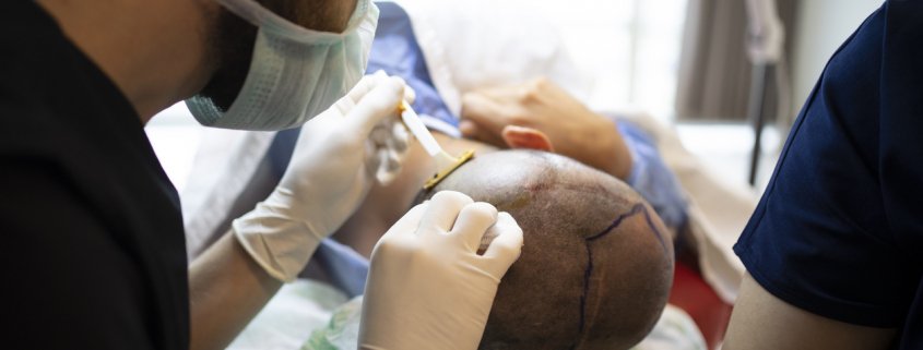 Hair transplant procedure in kansas city