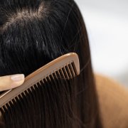 Problem of Young woman hair loss, with thin hair.