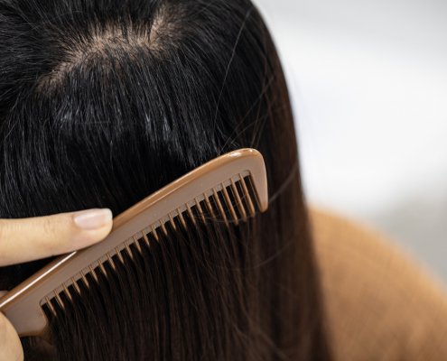 Problem of Young woman hair loss, with thin hair.
