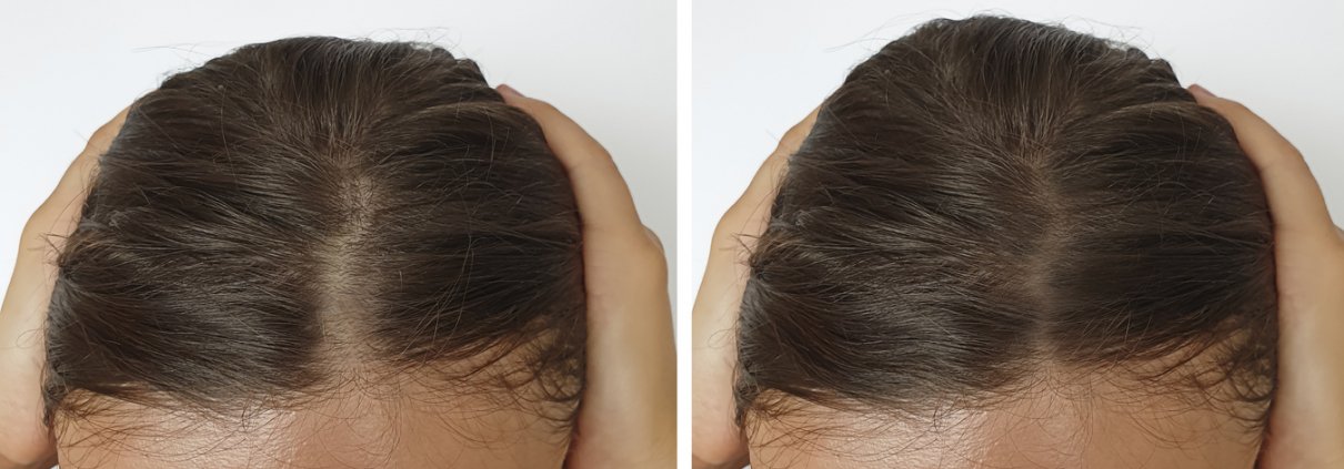 Woman baldness hair before and after hair transplant