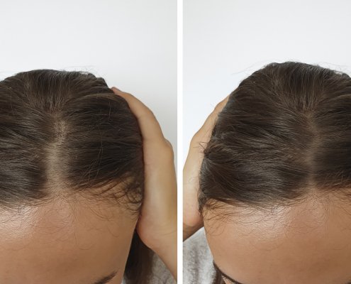 Woman baldness hair before and after hair transplant
