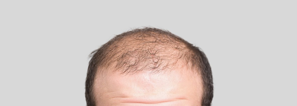 Man with thinning hair