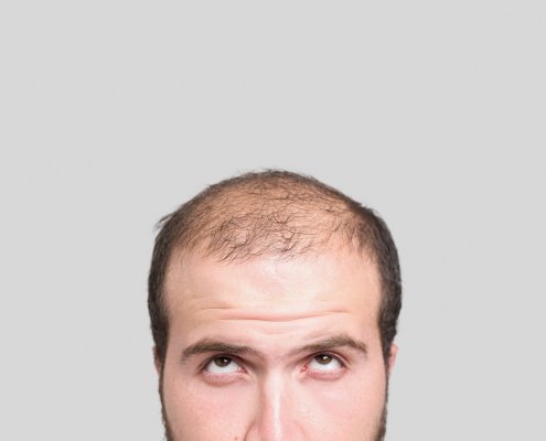 Man with thinning hair