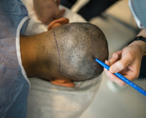 A man undergoing Hair Transplant Surgery.