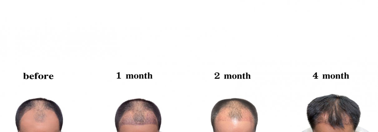 Hair transplantation surgery steps