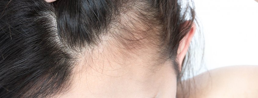 Young woman with hair thinning