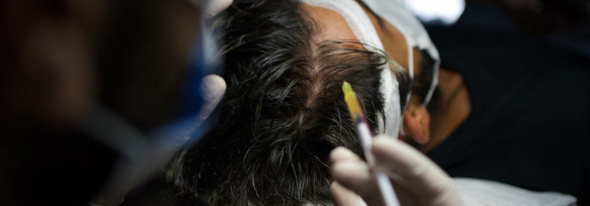 Man with hair loss problem receiving injection in head