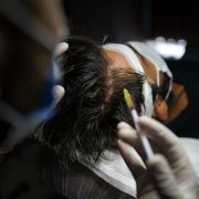 Man with hair loss problem receiving injection in head