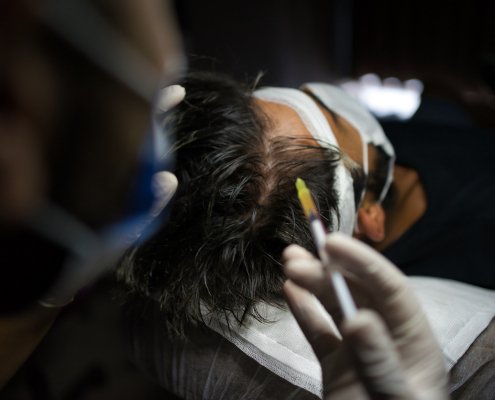 Man with hair loss problem receiving injection in head