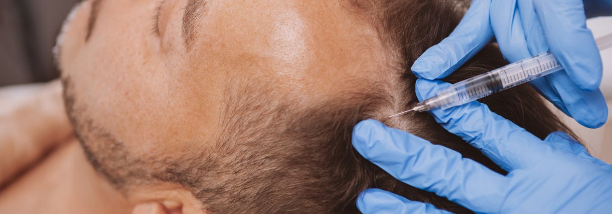 Doctor performing hair loss treatment