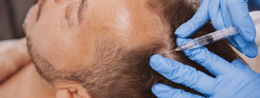 Doctor performing hair loss treatment