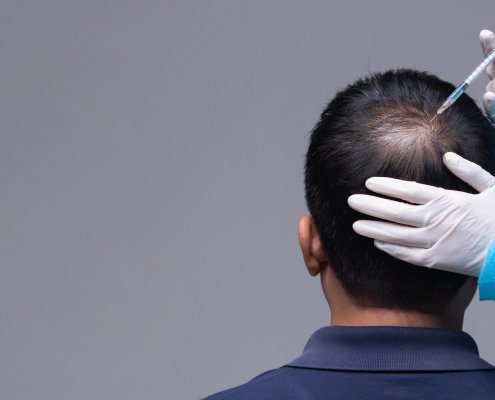 Doctor Treating Hair Loss