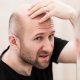 A balding man contemplating hair replacement.